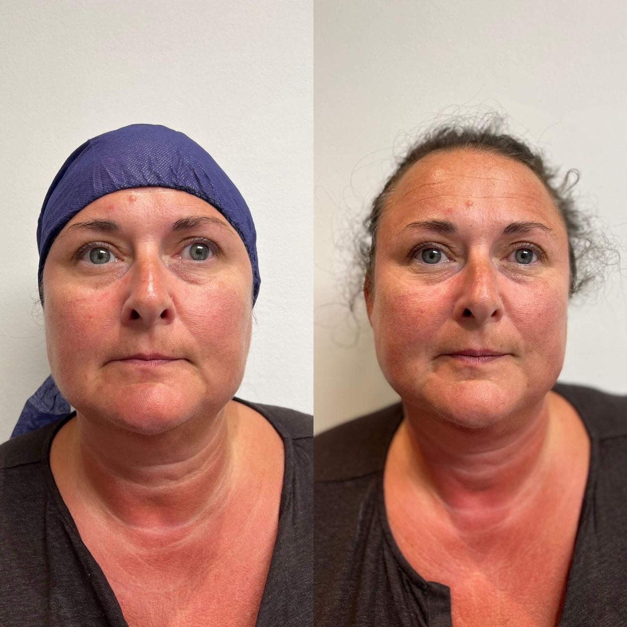 Endolift In London NonSurgical Facelift Endolift before and after