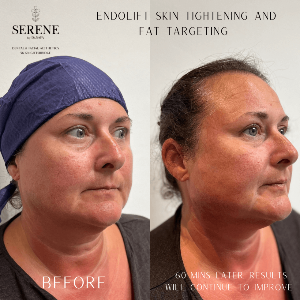 Endolift In London NonSurgical Facelift Endolift before and after